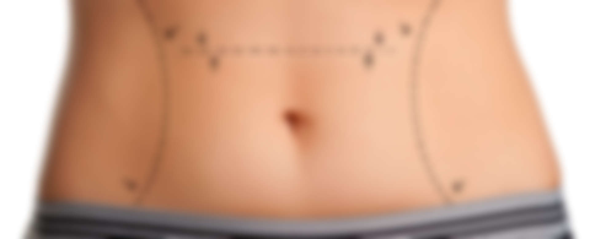 Tummy tuck (abdominoplasty)